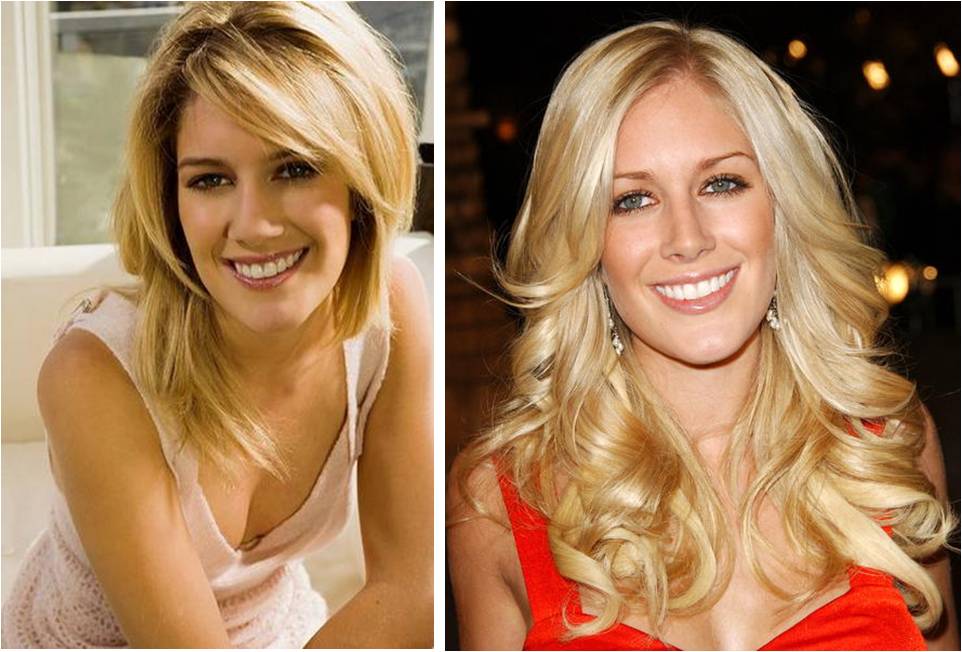 heidi montag before and after plastic surgery interview. montag before heidiapr