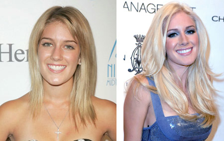 heidi montag after surgery 2010. As you can see Ms. Montag has